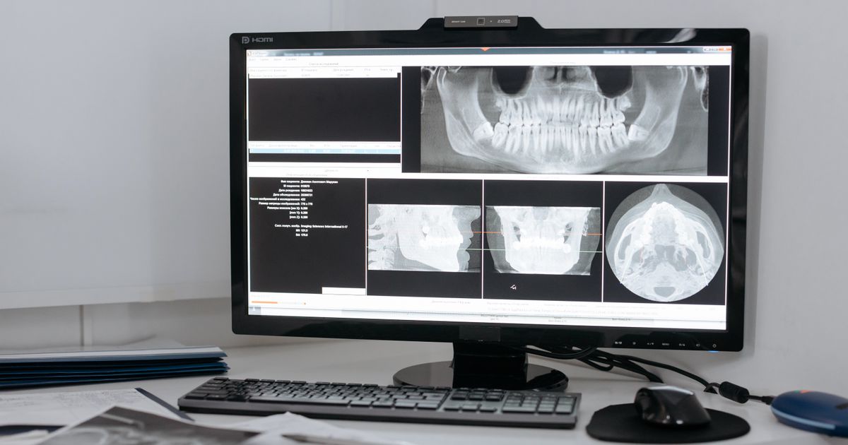 XAI w PET-CT: heatmapa, pojęcia czy logika modelu?
